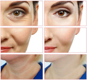 Age-Defying Secrets: Discover How to Eliminate Facial Wrinkles Without Surgical Procedures